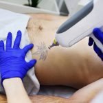 9 Factors That Determine Tattoo Removal Success