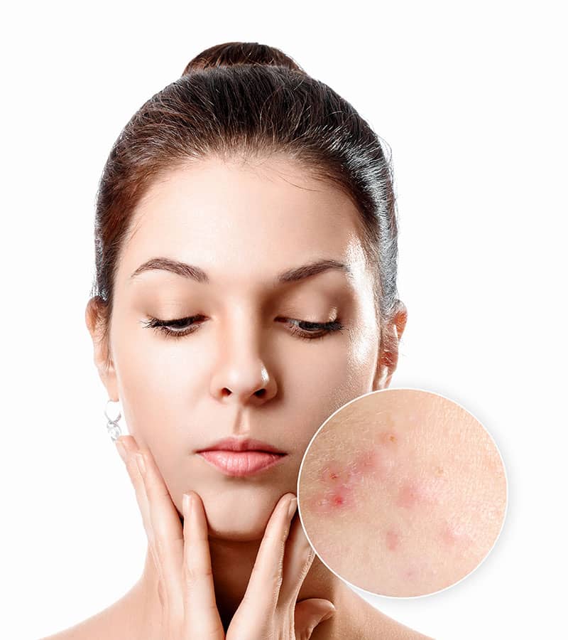 Laser acne treatment service