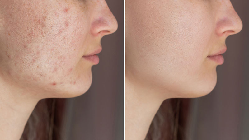 acne scar removal