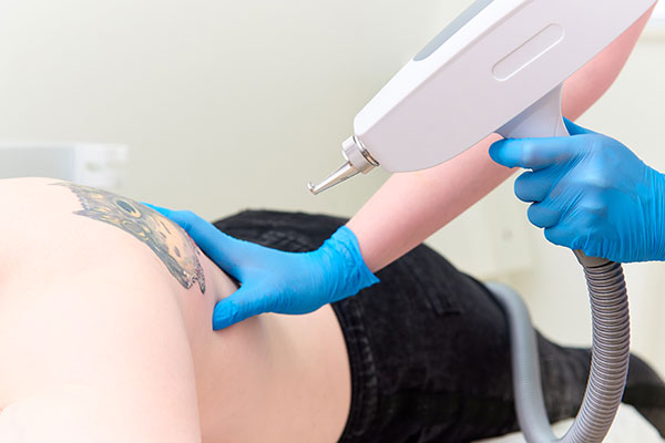 procedure removal tattoo picosecond technology