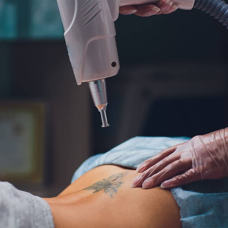 professional tattoo removal laser Madison WI