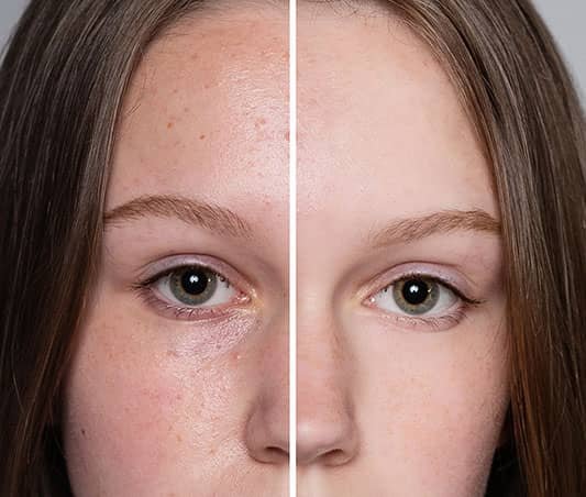 skin care before after acne treatment