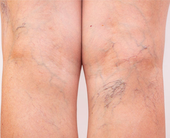 Laser Spider Vein Removal Treatment
