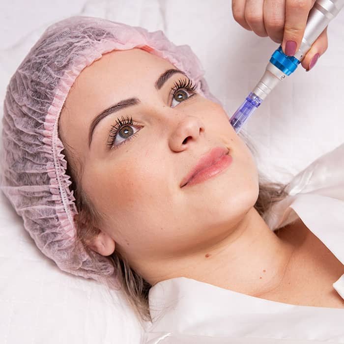 Microneedling therapy Madison Wi