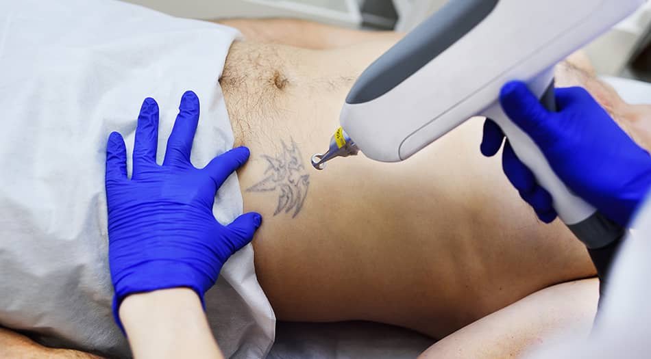 Safest way Laser Tattoo Removal
