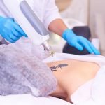 8 Benefits of Laser Tattoo Removal