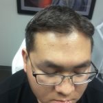 Before and After Skin Tag Laser Removal