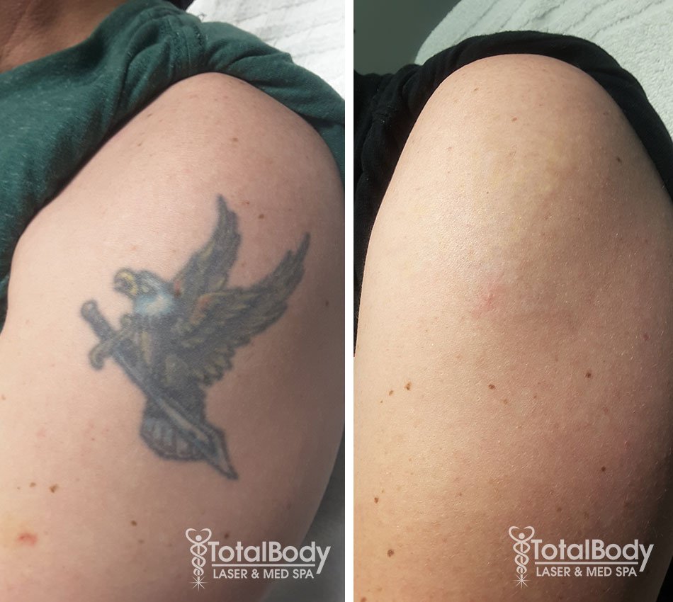 Laser Tattoo Removal Services North Little Rock, AR at Arkansas Laser and  Skin Care