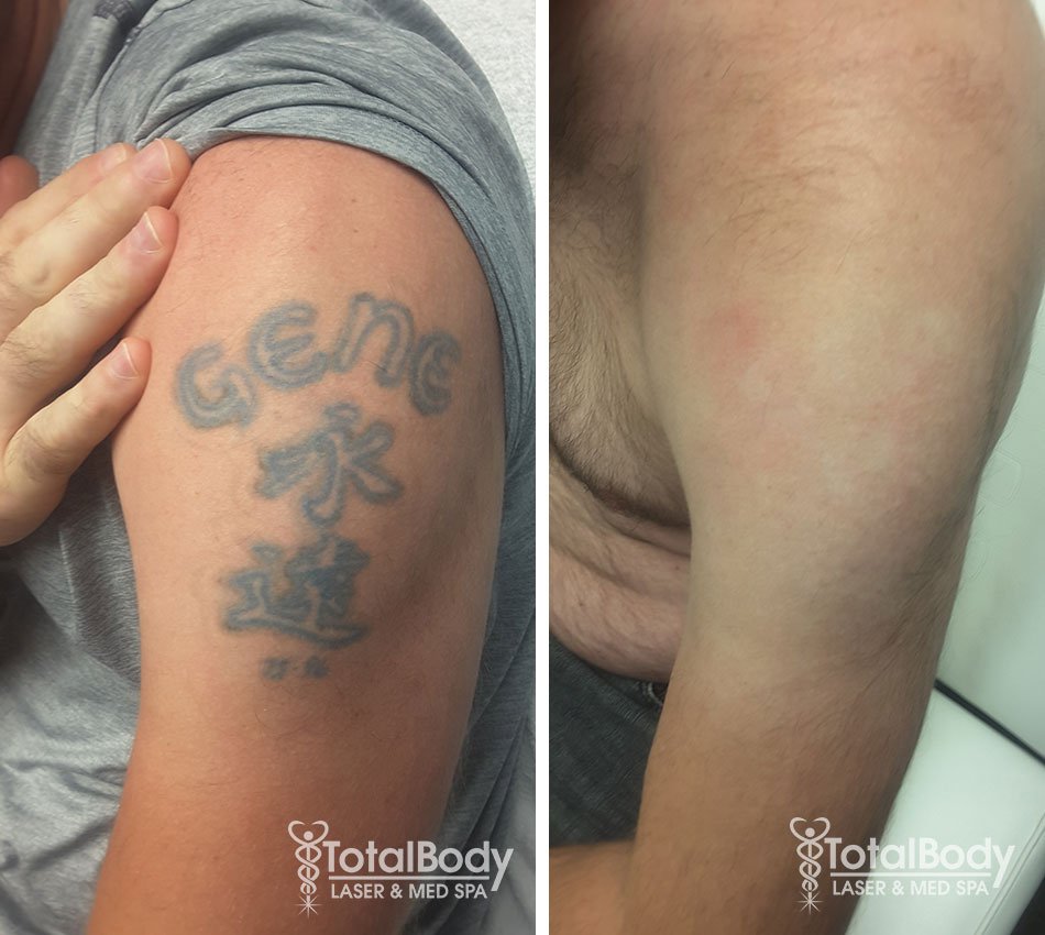 before after photo laser tattoo removal Madison