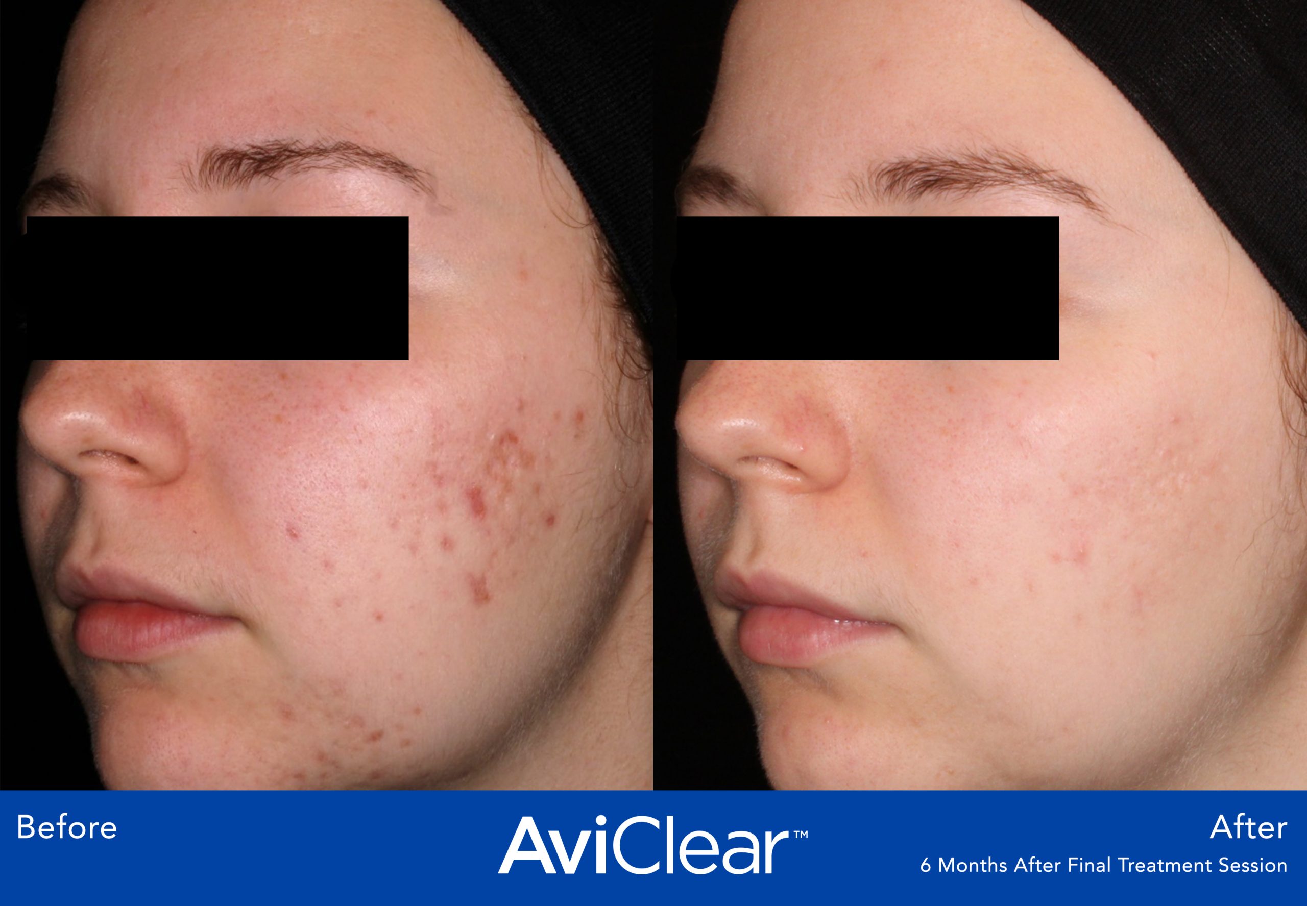 AviClear Before After 6 months after