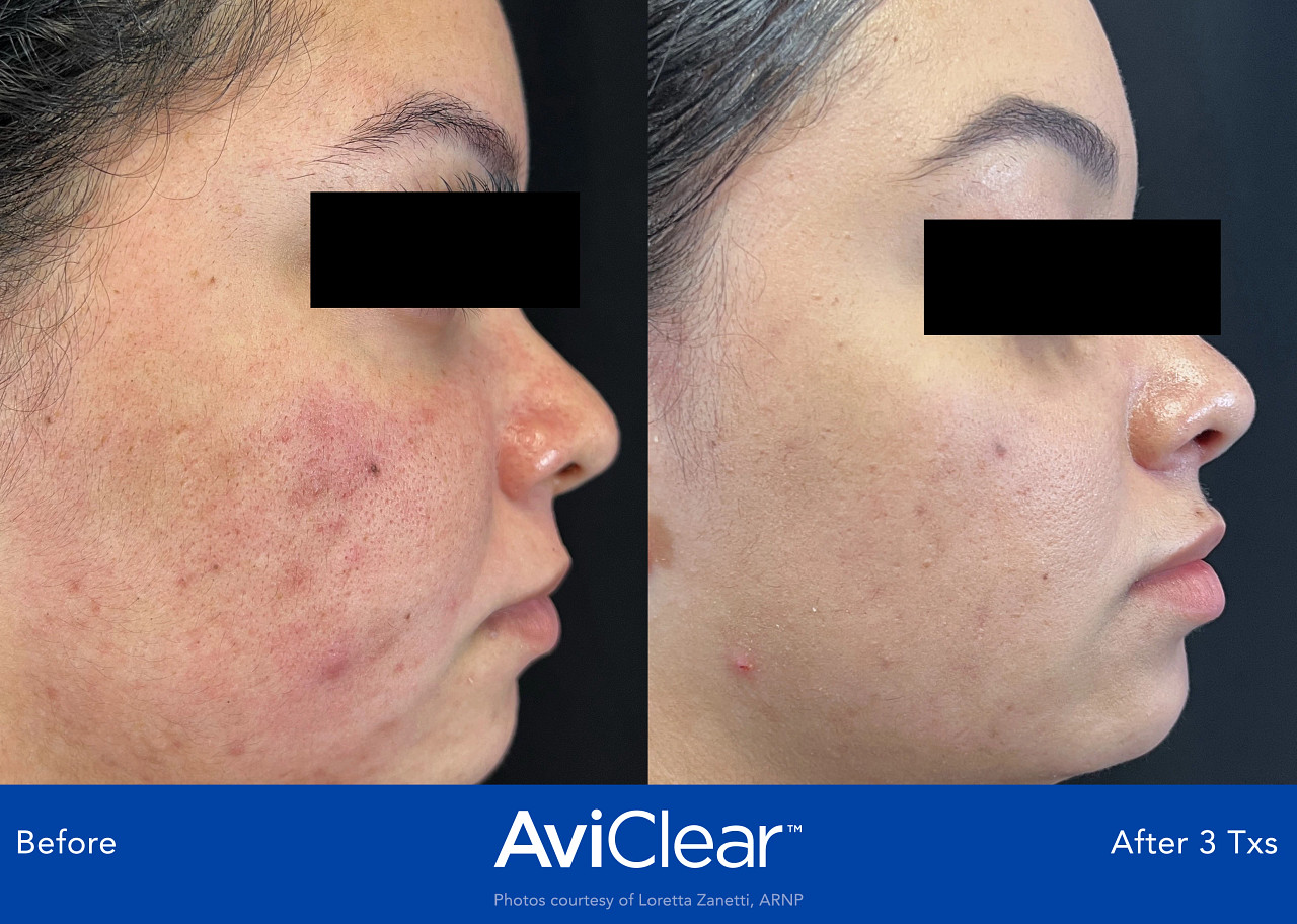 AviClear® Acne Laser Treatment