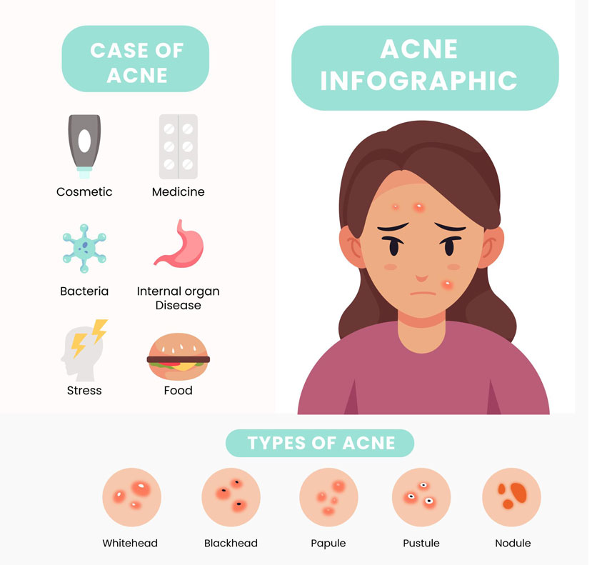 What is acne