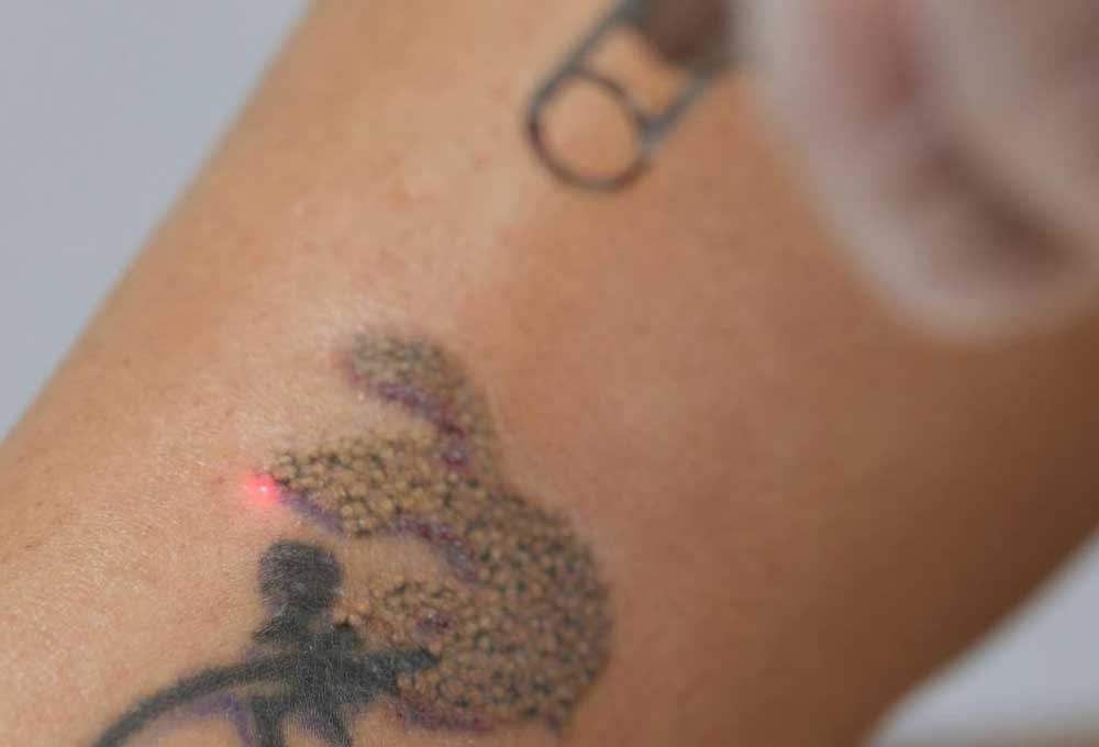 Choosing A Tattoo Removal Service in Madison Wi