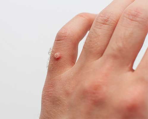 Professional wart removal in Madison