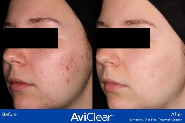AviClear Before After 6 months after