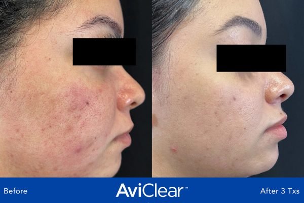 AviClear® Acne Laser Treatment