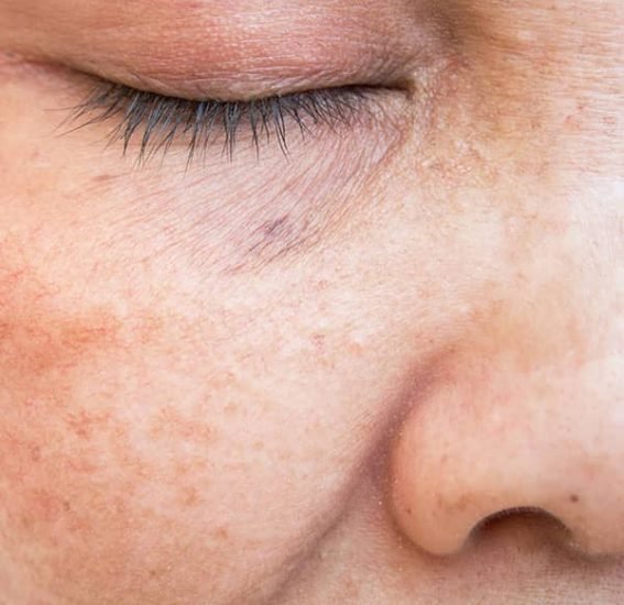 Laser Age and Liver Spot Removal