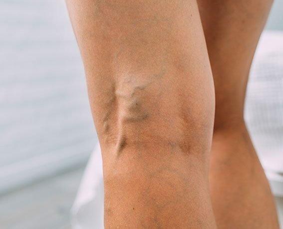 Laser Spider Vein procedure Madison WI