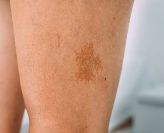Laser Treatment for Birthmark Removal Madison WI