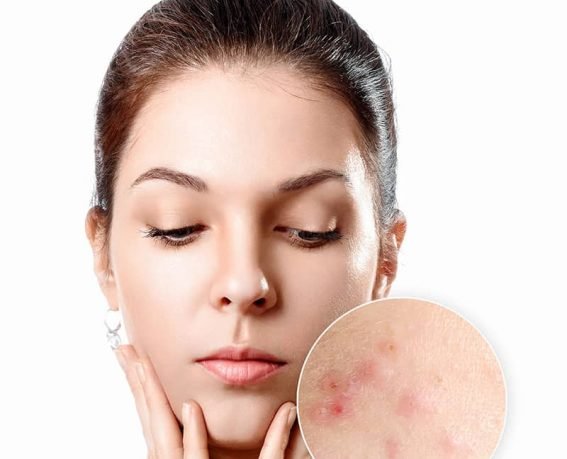 Laser acne treatment service
