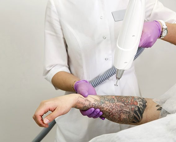 Picosure Laser Tattoo Removal process