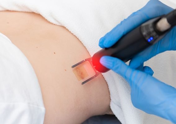 Laser Scar Removal Process