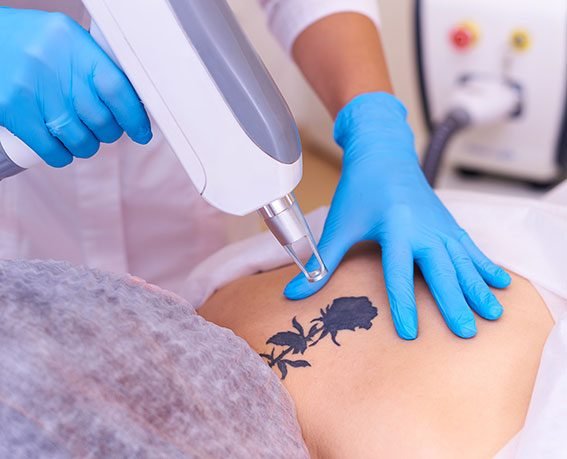 laser tattoo removal cosmetology