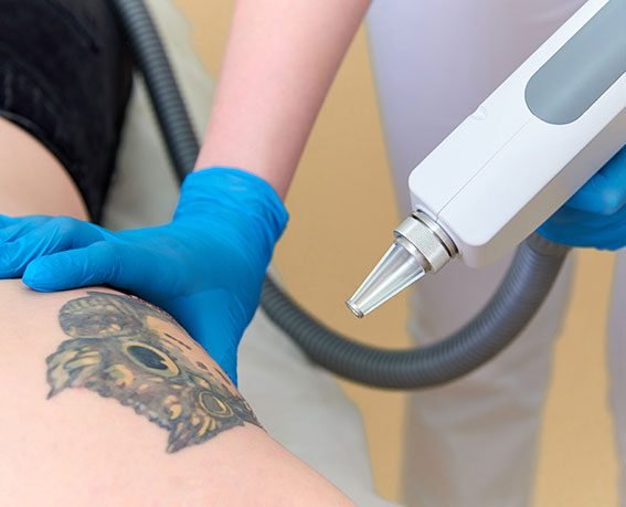 procedure removal tattoo laser Madison Wi