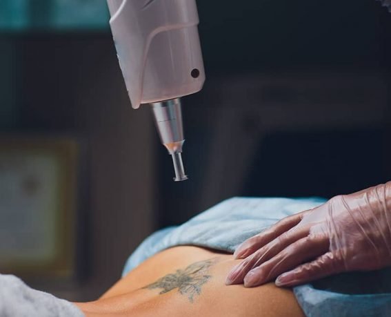 Connecticut Tattoo Removal Brings FullSpectrum Laser