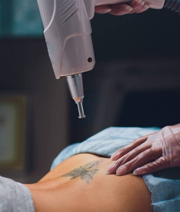 professional tattoo removal laser Madison WI