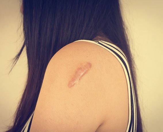 skin scar removal
