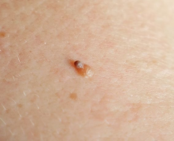 small mole with growth