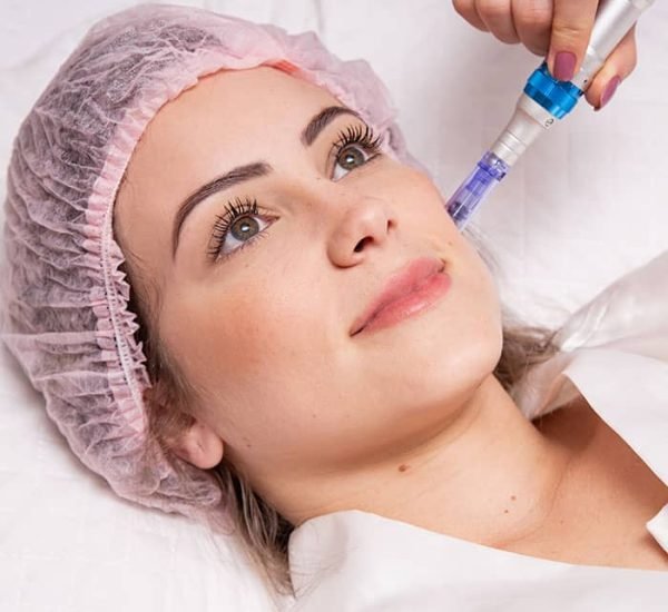 Microneedling therapy Madison Wi